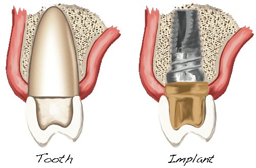 implant dentaire-dent dr Philippe Martin Genève Suisse